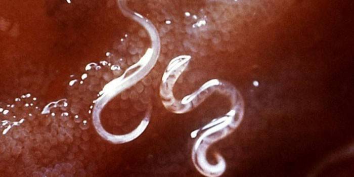 Pinworms az emberi testben