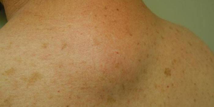 Lipoma lớn trên lưng của một người