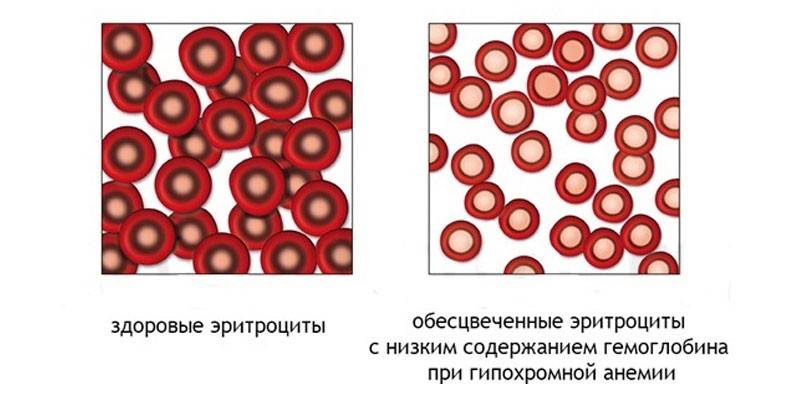 Raudonųjų kraujo kūnelių hipochromija