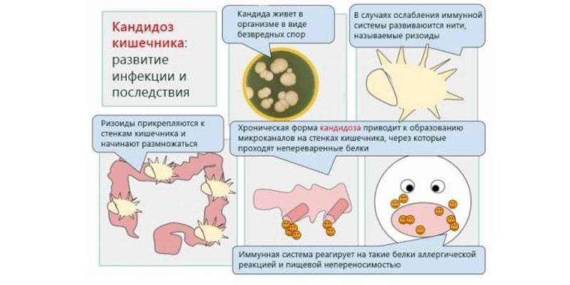 Nấm candida ruột - sự phát triển và hậu quả
