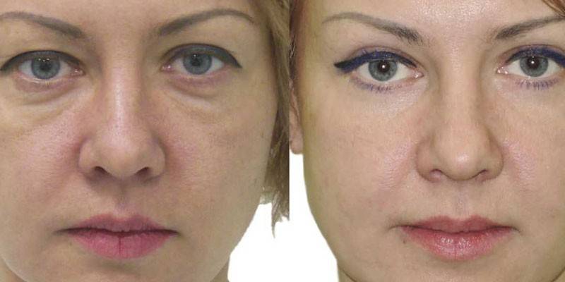 Woman before and after blepharoplasty