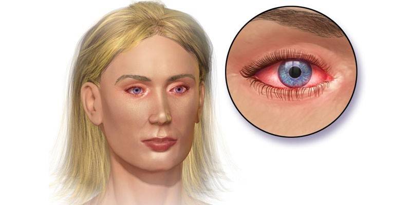 Conjunctivitis eye