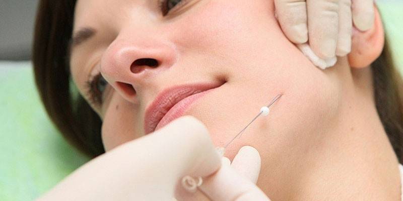 Procédure de renforcement de visage