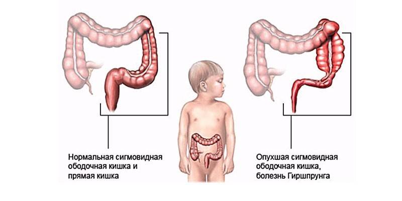 ลำไส้ใหญ่ sigmoid ปกติและโรค Hirschsprung