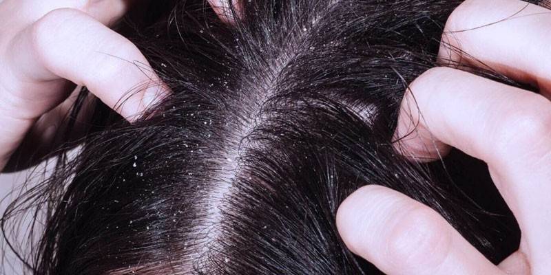 Pellicules sur les cheveux