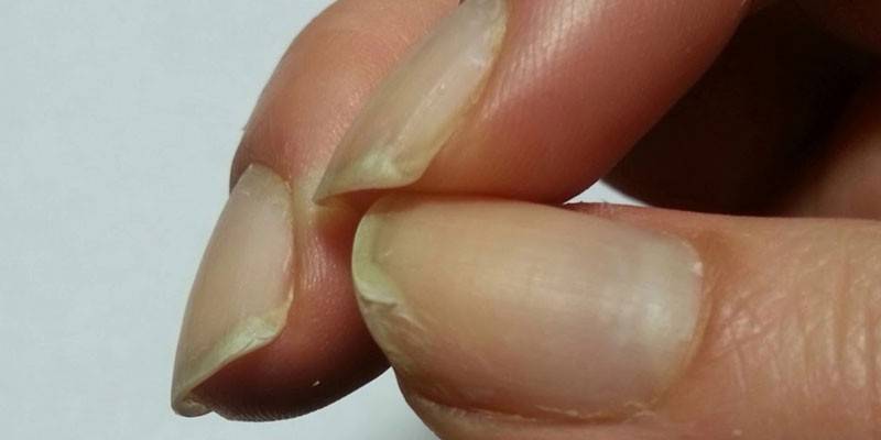 Esfoliação de unhas