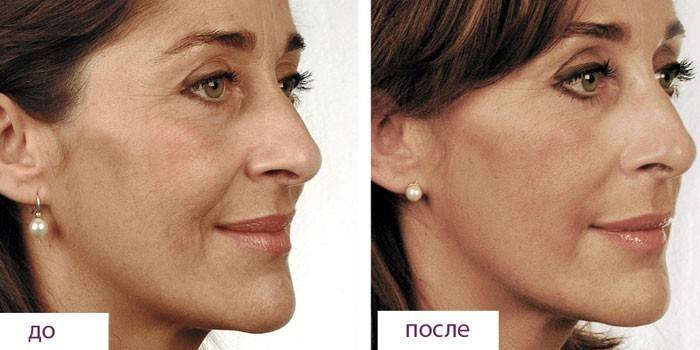 Fotó egy nőről a bioreparatúra előtt és után