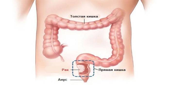 Cancer colorectal