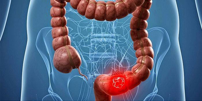 Oncologie du côlon sigmoïde
