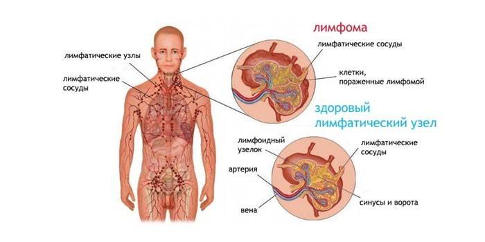 Linfoma