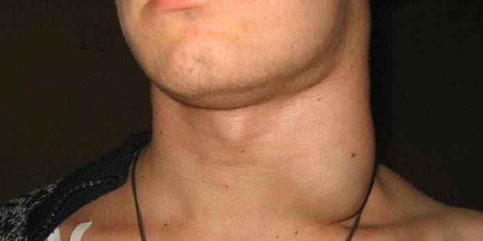Linfadenopatia cervical
