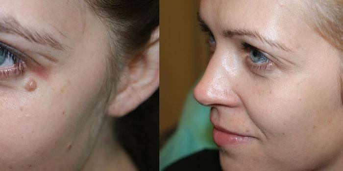 Antes e depois da remoção da toupeira