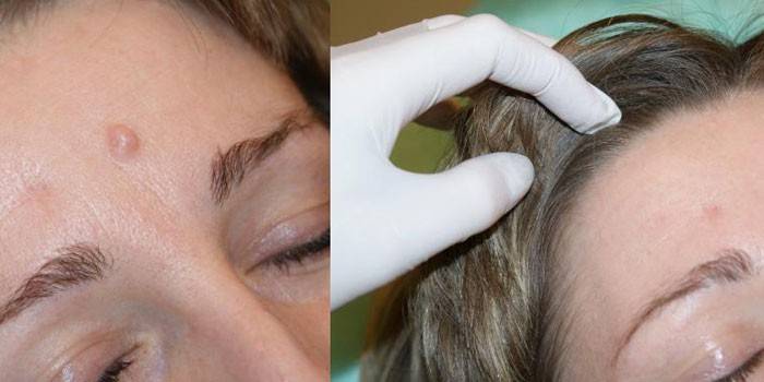 Antes e depois da criodestruição