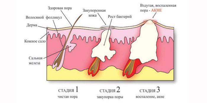 Μηχανισμός σχηματισμού Blackhead