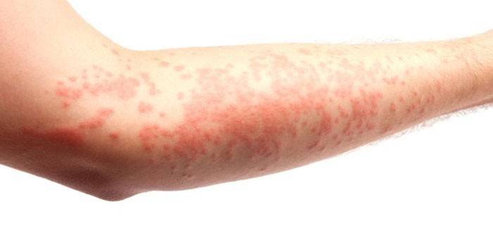 Urticaria en mano