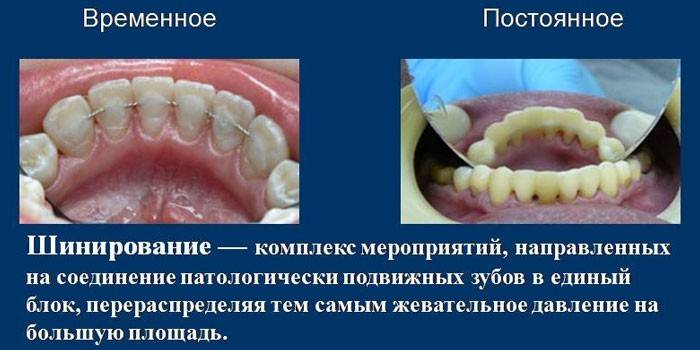 Προσωρινός και μόνιμος νάρθηκας
