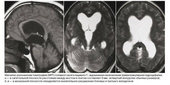 תוצאות MRI