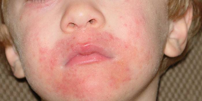 Munddermatitis im Gesicht eines Kindes