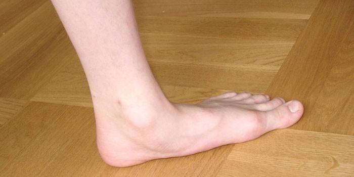 Pieds plats