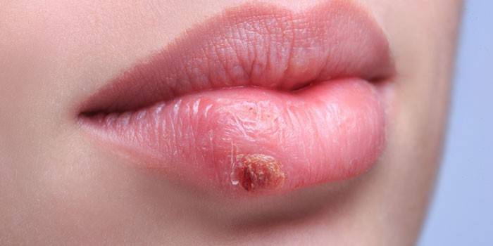 Herpes no lábio de uma menina