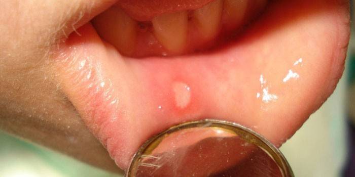 A manifestação de herpes na mucosa oral de uma criança