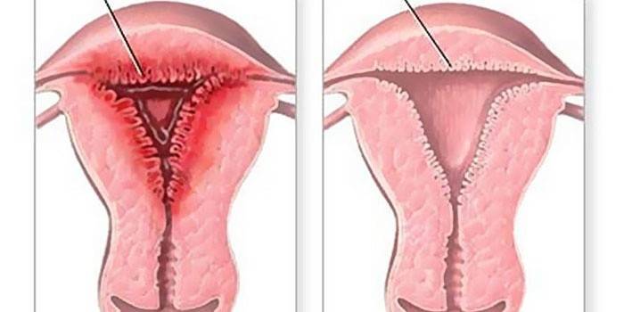 Kohdun endometriumin hyperplasian kaavio