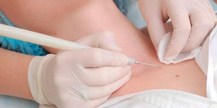 Rimozione del papilloma mediante elettrocoagulazione
