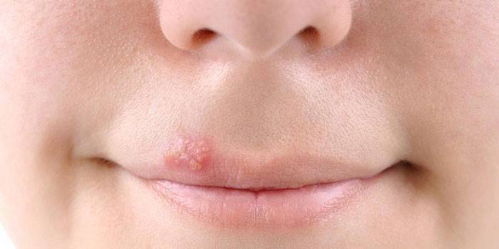 Herpes sul labbro superiore