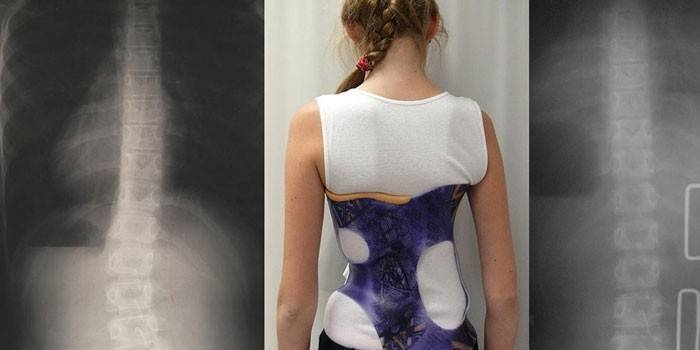 Scoliosi di 2 ° grado in una ragazza
