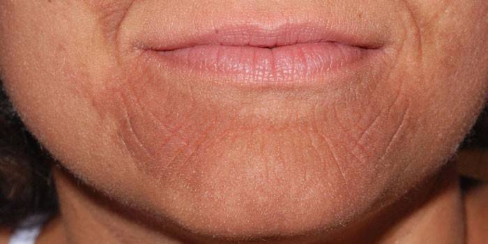 Eritrodermia ictiótica de la cara