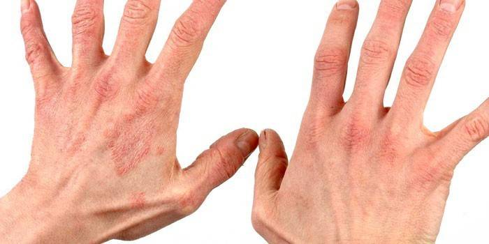 แดงบนผิวหนังของมือ