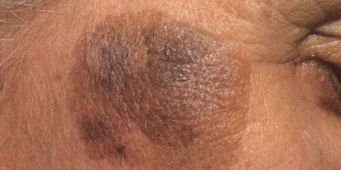 Kératome sénile sur le visage d'une femme