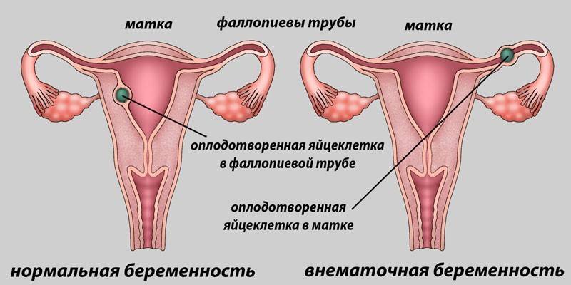 Нормална и ектопична трудноћа