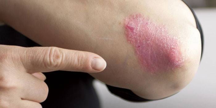 A psoriasis kezdeti stádiuma a könyök nőjénél