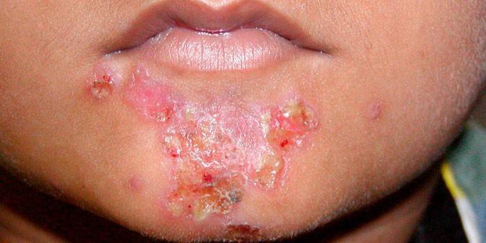 Infecção por estafilococos na pele