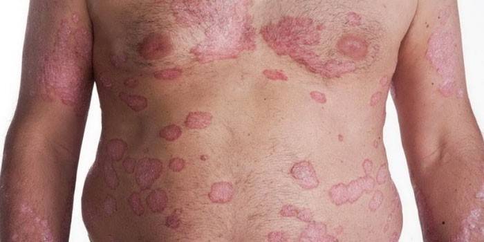 Psoriasis a testben