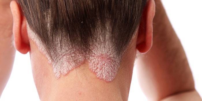Psoriazis pe partea occipitală a capului