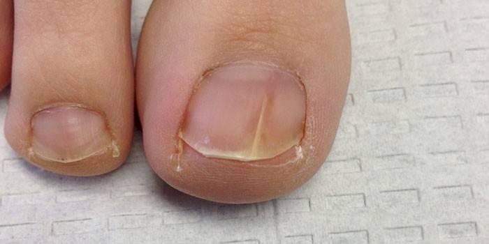 Toenail grybelis