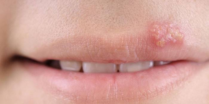 Herpes sul labbro superiore della ragazza