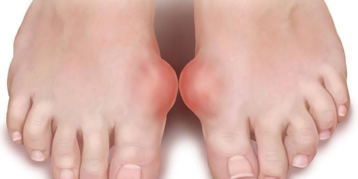 Gota en los pies