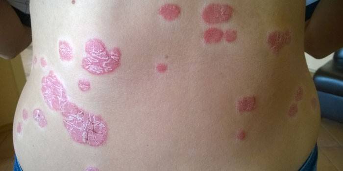 Psoriazė ant kūno