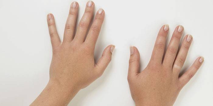 Mâinile unei fete cu sindrom Raynaud