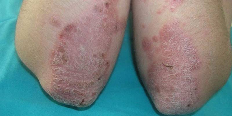 Psoriazinės alkūnės plokštelės