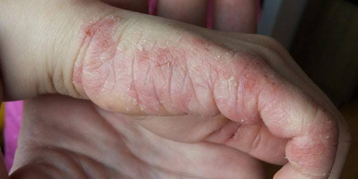 Atopinis dermatitas delne