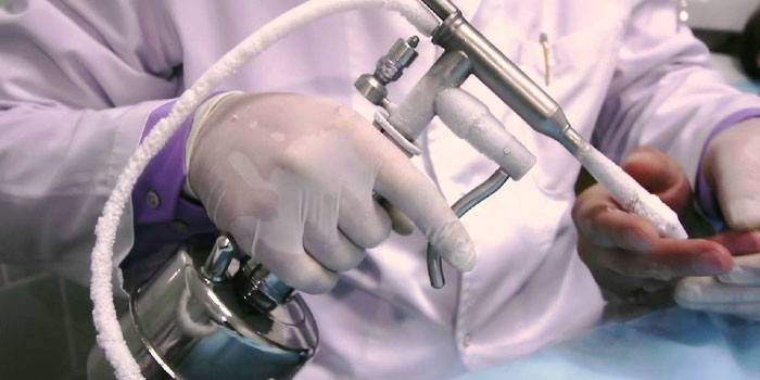 Un dispositif de cryodestruction dans les mains d'un docteur