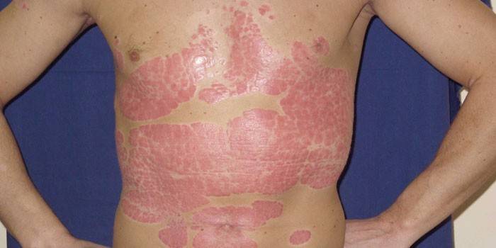 Psoriazinės kūno plokštelės
