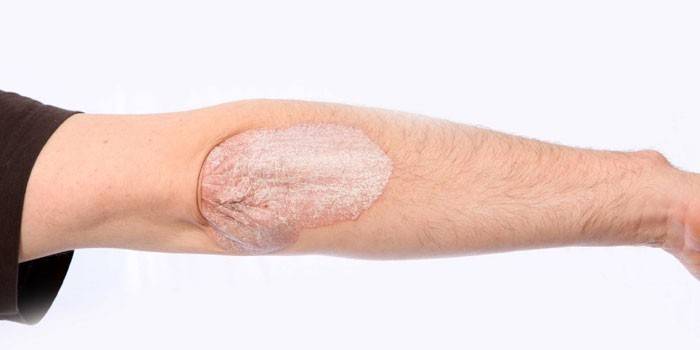 Psoriazės apraiškos ant vyro alkūnės odos