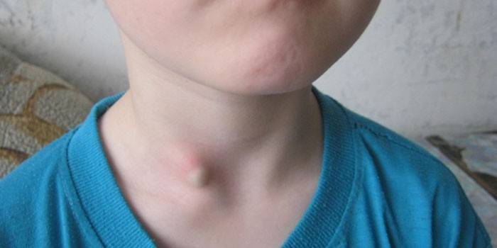 Zhirovik trên cổ trẻ con