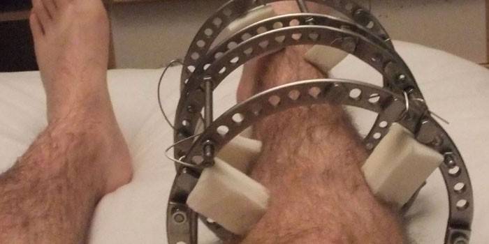 Appareil d’Ilizarov sur la jambe d’un homme