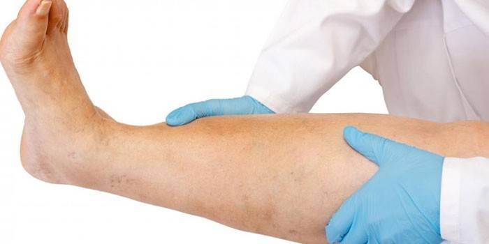 La deuxième étape de l'éléphantiasis